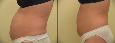 UltraShape before and after photo