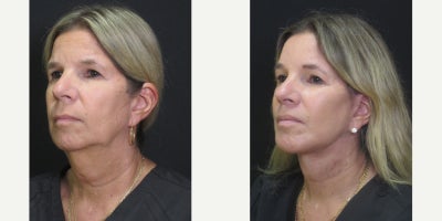 Deep Plane Facelift before and after photo