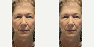 Eyelid Surgery before and after photo