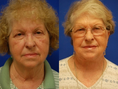Facelift before and after photo
