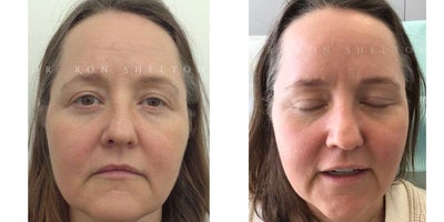 Fraxel Laser before and after photo