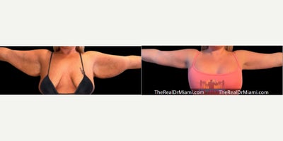 Arm Lift before and after photo