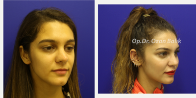 Facial Fat Transfer before and after photo