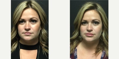 Juvederm before and after photo