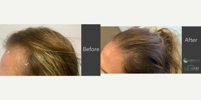 PRP for Hair Loss before and after photo