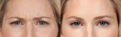 Botox before and after photo