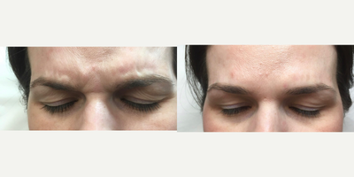 Botox before and after photo