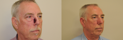 Facial Reconstructive Surgery before and after photo