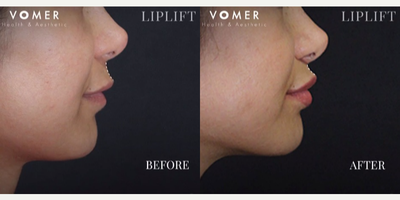 Lip Lift before and after photo
