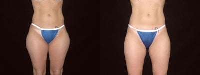 Liposuction before and after photo