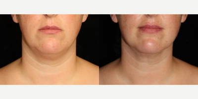 Liposuction before and after photo