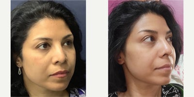 Rhinoplasty before and after photo
