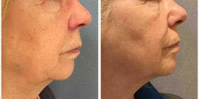 Chemical Peel before and after photo