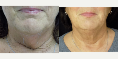 Kybella before and after photo
