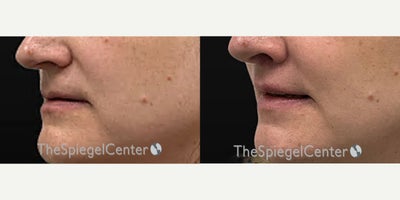 Lip Lift before and after photo