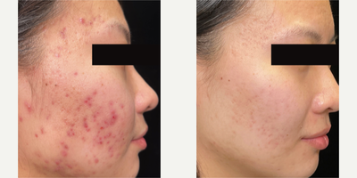 AviClear before and after photo