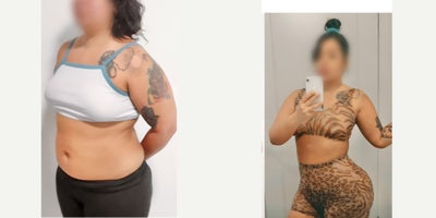 Brazilian Butt Lift before and after photo