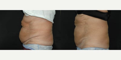CoolSculpting before and after photo