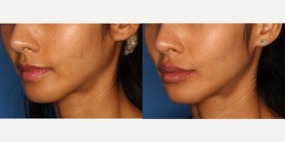 Lip Fillers before and after photo