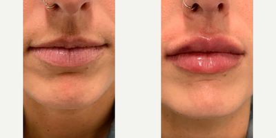 Lip Fillers before and after photo