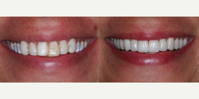 Porcelain Veneers before and after photo