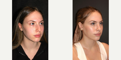 Rhinoplasty before and after photo