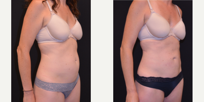 BodyTite before and after photo