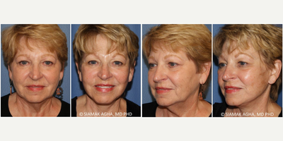 Facelift before and after photo