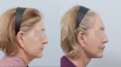 Facelift before and after photo
