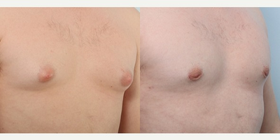 Gynecomastia Surgery before and after photo