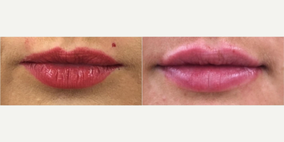 Lip Fillers before and after photo