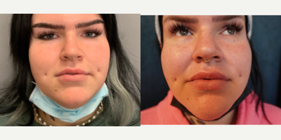 Lip Fillers before and after photo