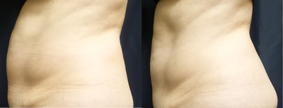 SculpSure before and after photo