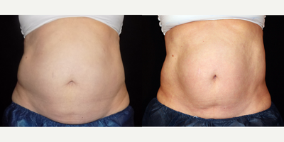 CoolSculpting before and after photo