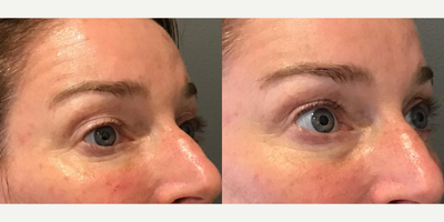 Dermal Fillers before and after photo