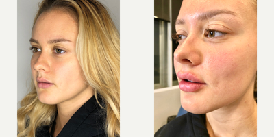 Lip Fillers before and after photo