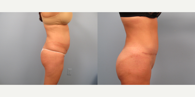 Mommy Makeover before and after photo