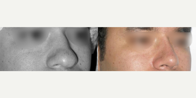 Rhinoplasty before and after photo