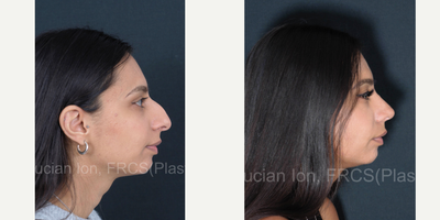 Asian Rhinoplasty before and after photo