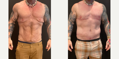 Body Lift before and after photo