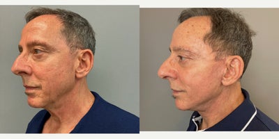 Facelift before and after photo