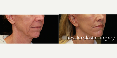 Laser Resurfacing before and after photo