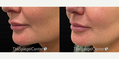 Lip Fillers before and after photo