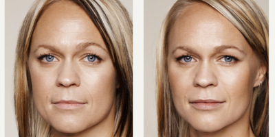 Restylane before and after photo