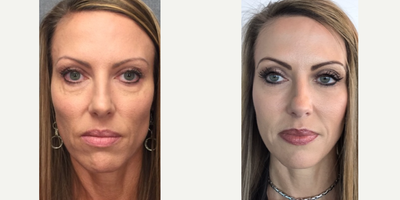 Sculptra before and after photo