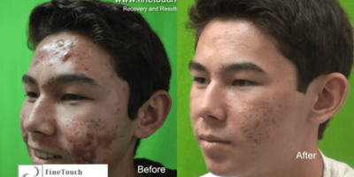 Fraxel Repair before and after photo