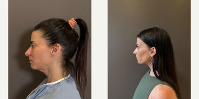 Neck Lift before and after photo