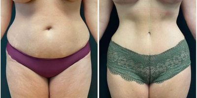Tummy Tuck before and after photo