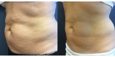 Vanquish before and after photo