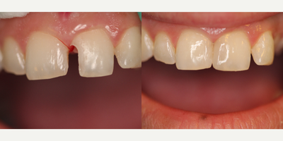 Dental Bonding before and after photo
